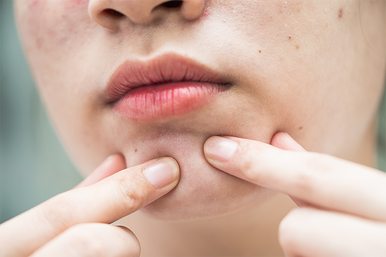 A Complete Guide On Acne-Causing Ingredients: