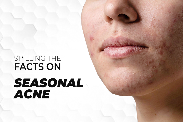 Spilling Facts On Seasonal Acne